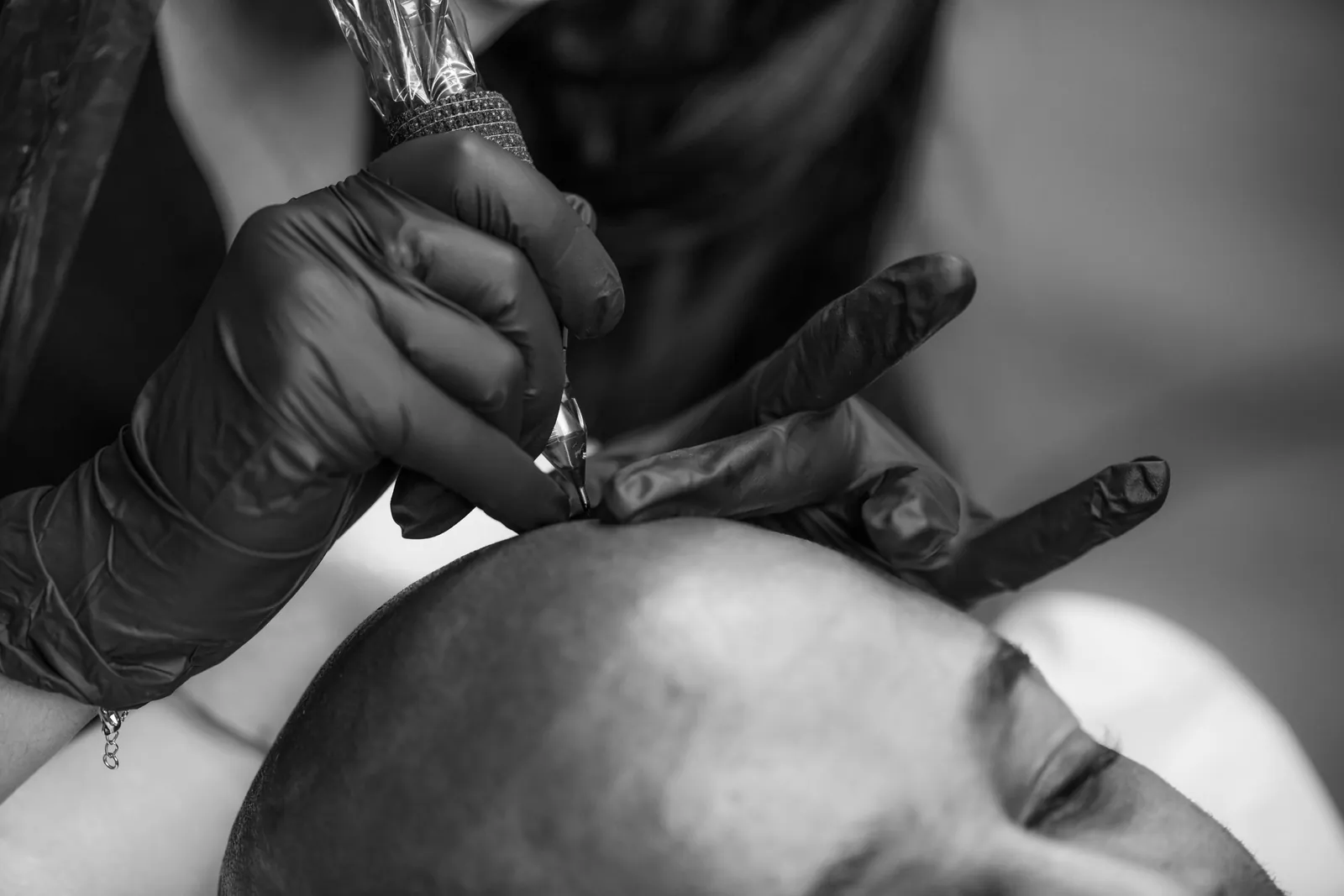 Close-up of a scalp micropigmentation treatment in progress on the top of a client's head