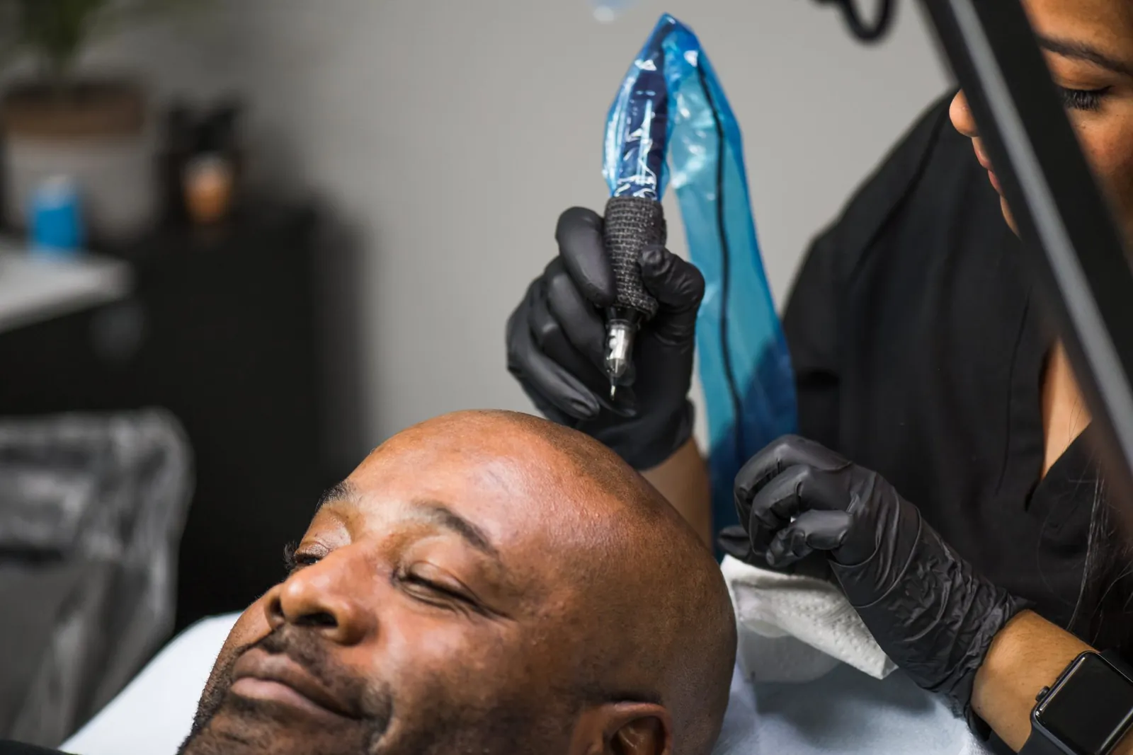 Detail of a scalp micropigmentation needle creating pigment impressions on a scalp