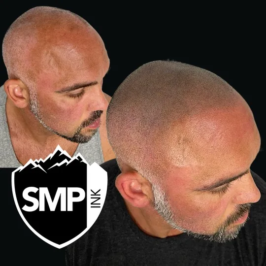 Scalp micropigmentation result — restored hairline with a clean buzzed look