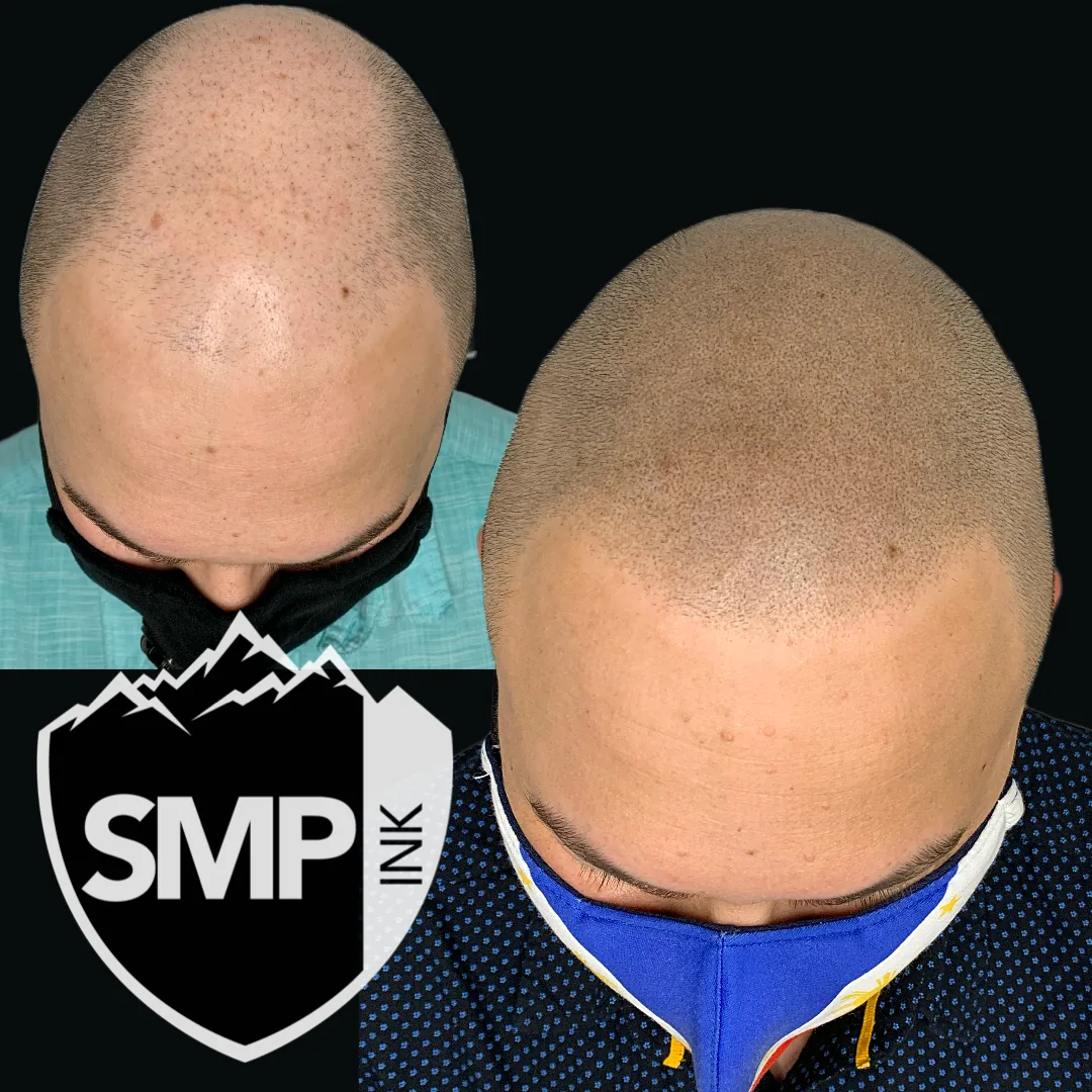 Scalp micropigmentation hybrid hairline result by SMP INK Seattle