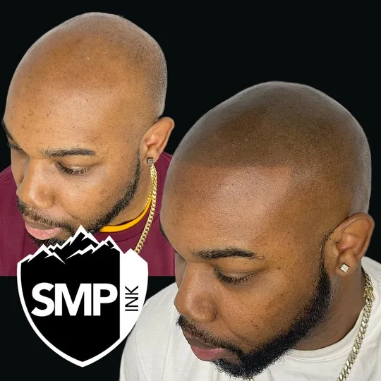 Scalp micropigmentation result — full coverage buzzed look by SMP INK Seattle