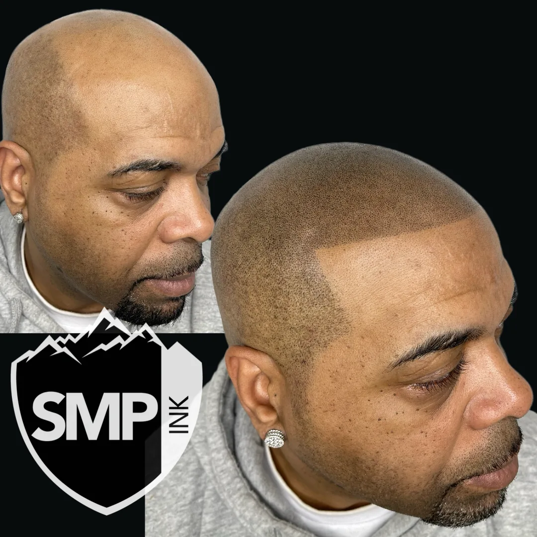 Scalp micropigmentation hard-line hairline design by SMP INK Seattle
