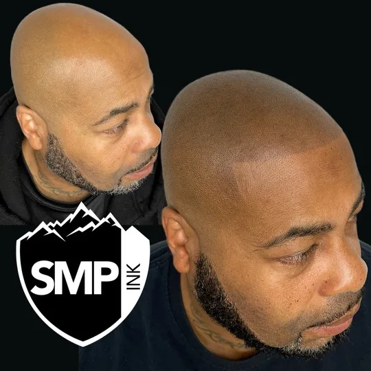 Scalp micropigmentation result — restored crown coverage by SMP INK Seattle