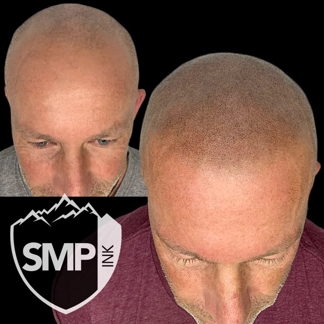 Scalp micropigmentation natural-line soft hairline design by SMP INK Seattle