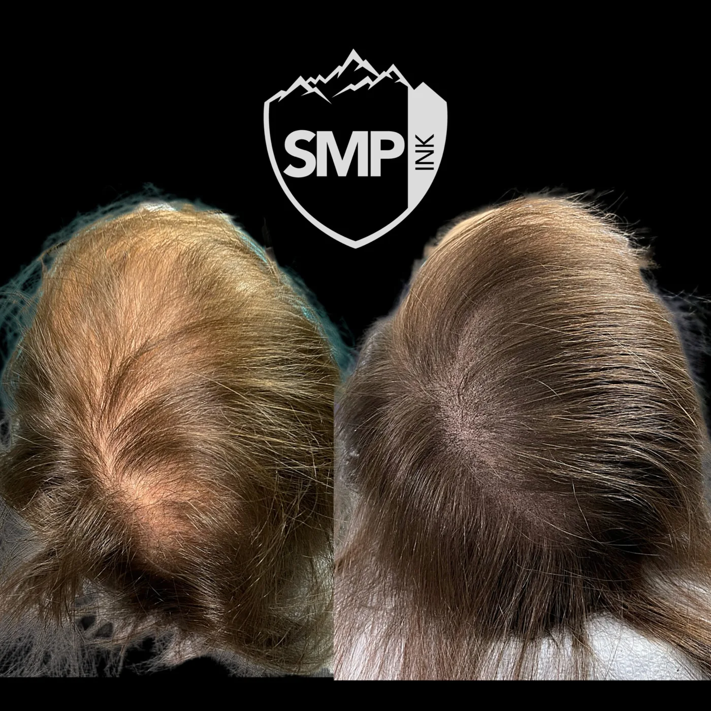 Scalp micropigmentation hair density result for a female client by SMP INK Seattle