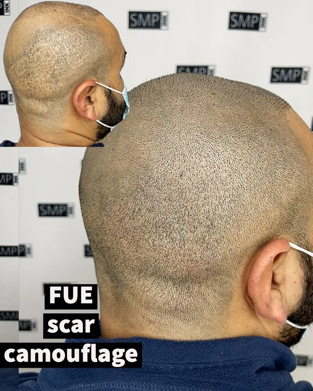 FUE hair transplant scar camouflage result by SMP INK Seattle