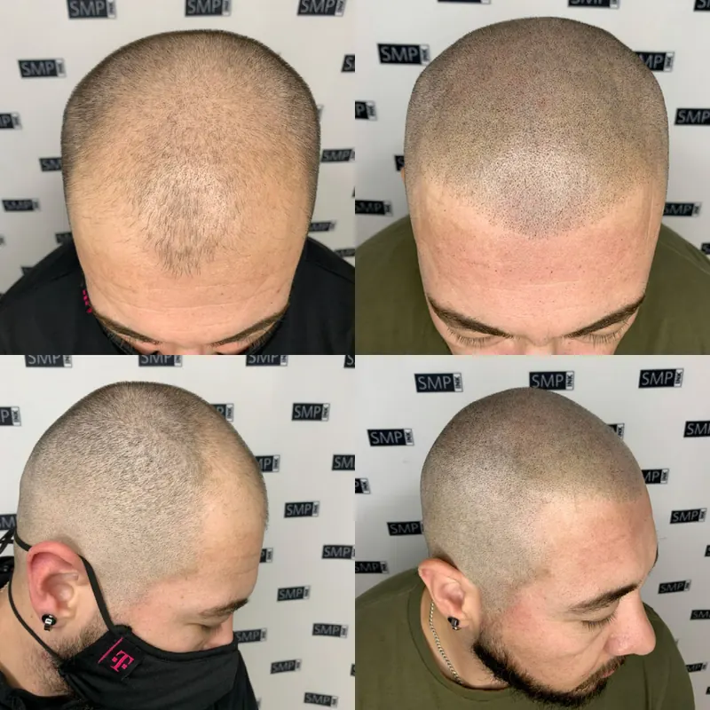 Scalp micropigmentation and permanent makeup client result from the SMP INK Seattle gallery