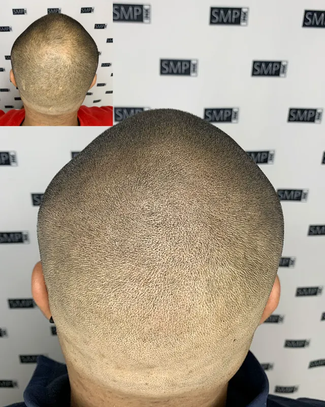 Scalp micropigmentation and permanent makeup client result from the SMP INK Seattle gallery