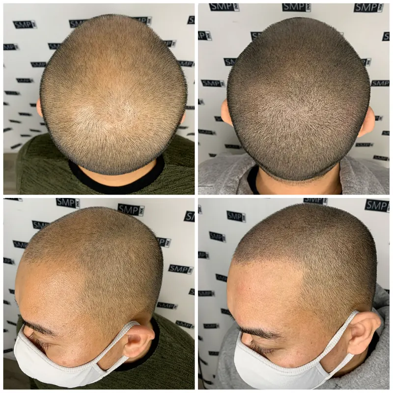 Scalp micropigmentation and permanent makeup client result from the SMP INK Seattle gallery
