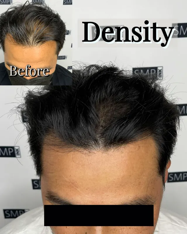 Scalp micropigmentation hair density result by SMP INK Seattle