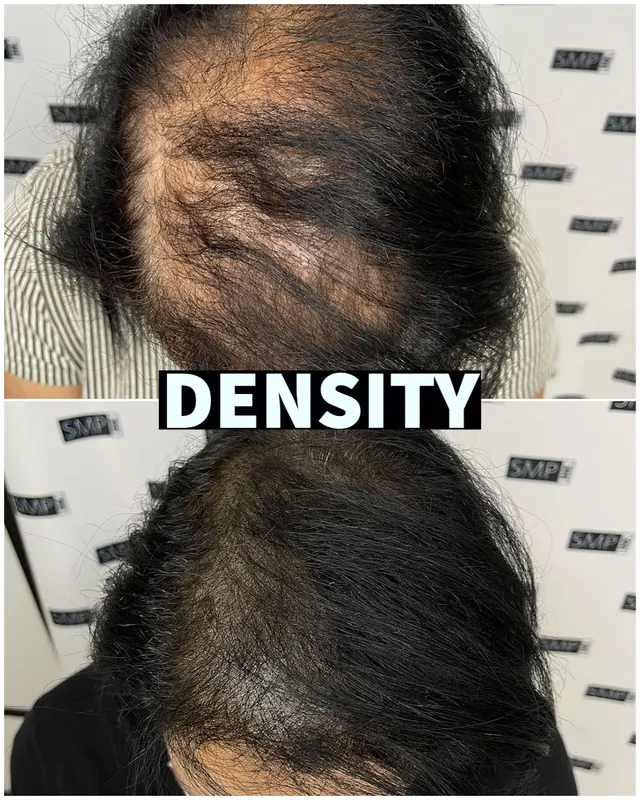 Scalp micropigmentation hair density result by SMP INK Seattle