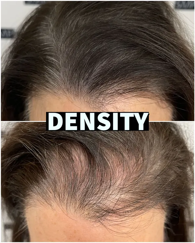 Scalp micropigmentation hair density result by SMP INK Seattle