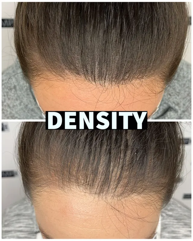 Scalp micropigmentation hair density result by SMP INK Seattle
