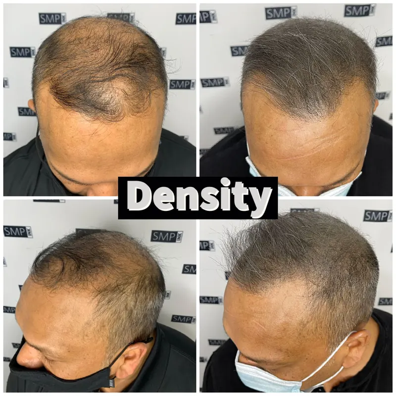 Scalp micropigmentation hair density result by SMP INK Seattle