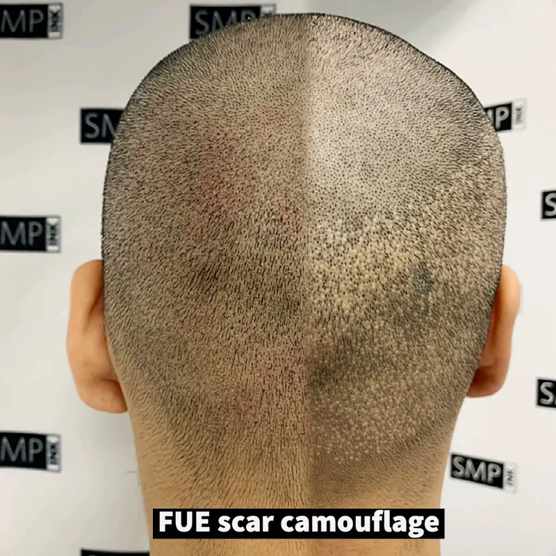 FUE hair transplant scar camouflage result by SMP INK Seattle