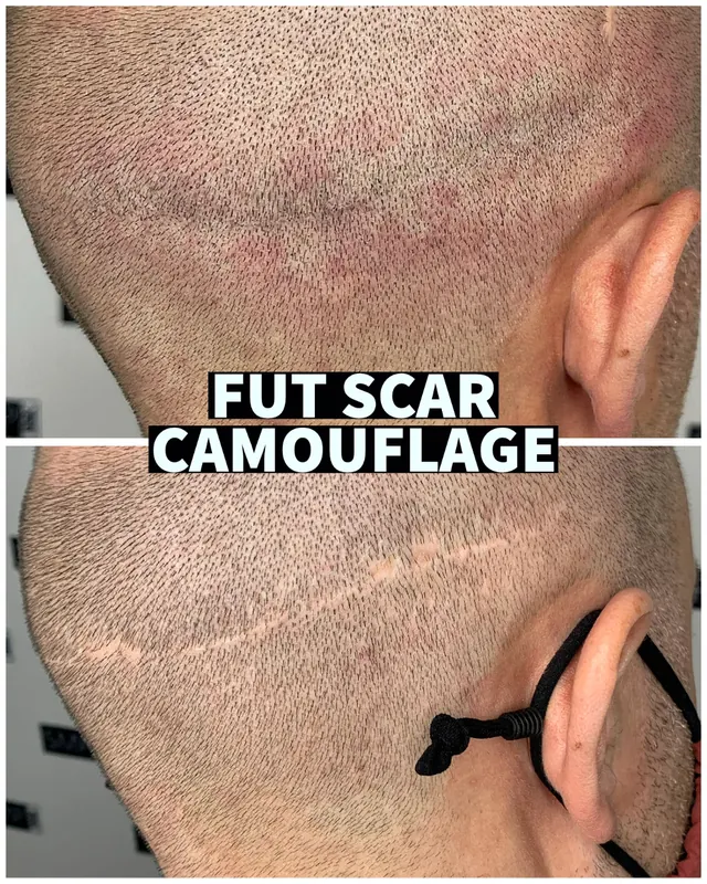 FUE hair transplant scar camouflage result by SMP INK Seattle