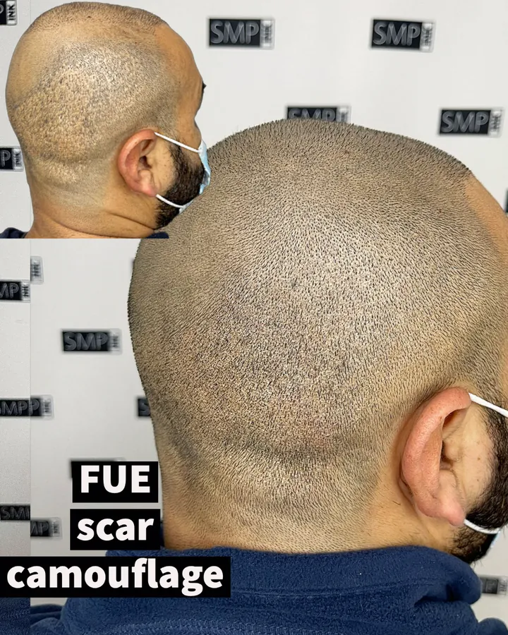 Scar camouflage scalp micropigmentation result by SMP INK Seattle