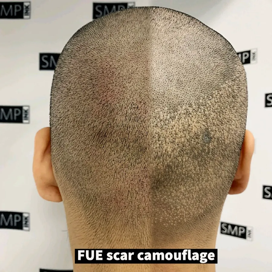 Scalp micropigmentation scar camouflage result by SMP INK Seattle