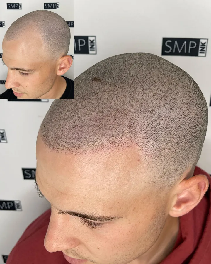 Scalp micropigmentation hairline restoration result by SMP INK Seattle