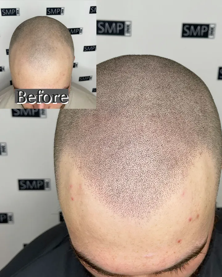Scalp micropigmentation hairline restoration result by SMP INK Seattle