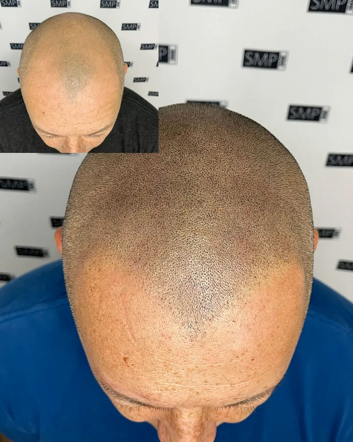 Scalp micropigmentation hairline restoration result by SMP INK Seattle